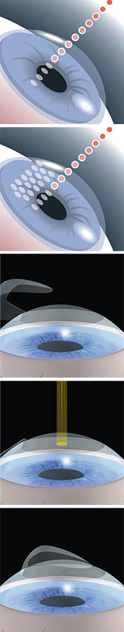 laser-stufen