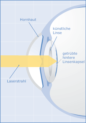 inhalte-kapselfibrose-augenaerzte-pforzheim